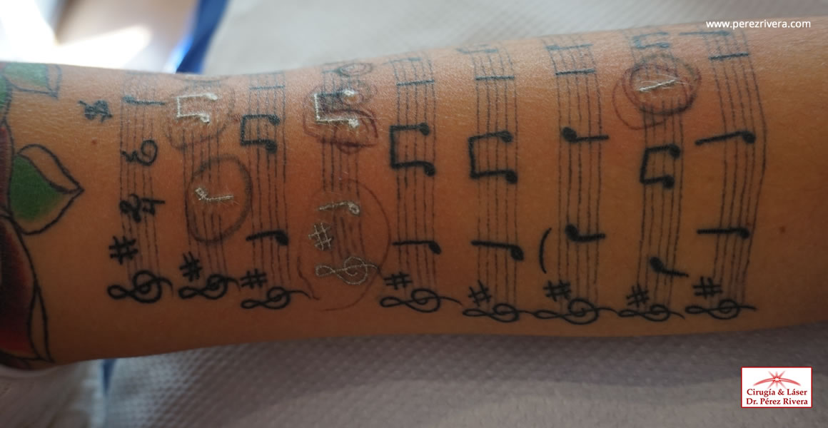 Arreglando un tatuaje